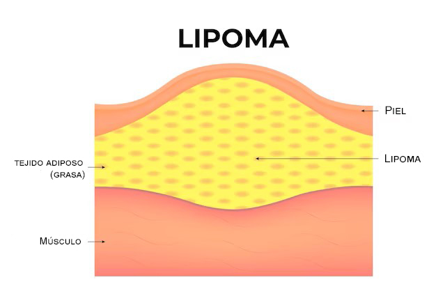 Lipoma