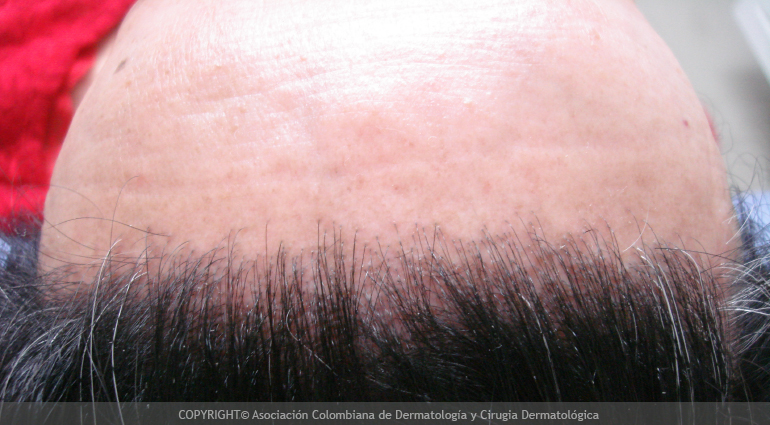 Alopecia areata