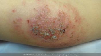 Dermatitis
