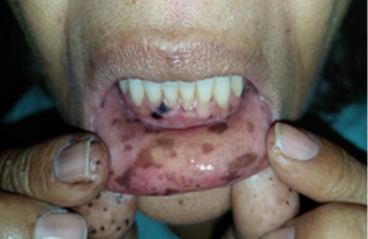 CASO 286: Manchas distribuidas en piel y mucosas. Evaluación del caso.